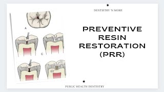 PRRPREVENTIVE RESIN RESTORATION [upl. by Aliuqaj]