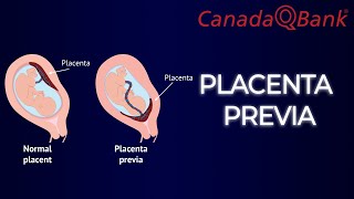 Placenta Previa [upl. by Annaed]