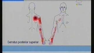 Dolores de los brazos originados por Nódulos Dolorosos Trigger Points  Dr Isaac Jakter [upl. by Alliuqal376]