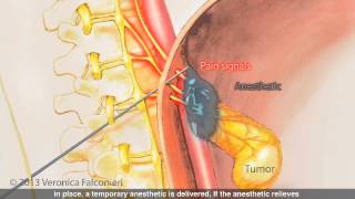 Celiac Plexus Block for Pancreatic Cancer Pain [upl. by Eleni]