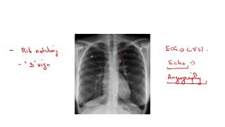 Coarctation of aorta  signs and symptoms CXR finding ECG echo management [upl. by Stempson]