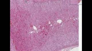 Histopathology AdrenalCortical adenoma [upl. by Ahsieyk406]