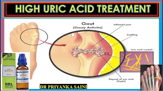 Hyperuricemia  High uric acid level in blood  HOMEOPATHY TREATMENT drpriyankashomeopathy [upl. by Adiesirb643]