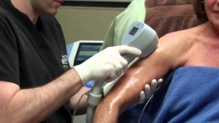 Exilis for Skin Tightening on a Womans Arms with Dr Seiler [upl. by Leith]