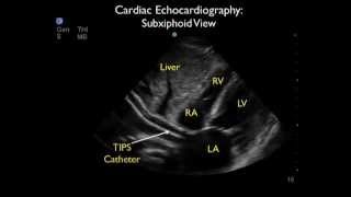 Transjugular Intrahepatic Portosystemic Shunt Migration to the Heart Diagnosed by ED Ultrasound [upl. by Nawd113]