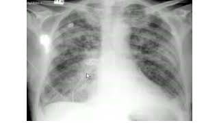 Pulmonary edema XRay review [upl. by Sremlahc408]