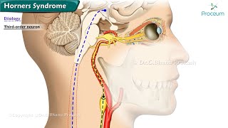 Horners Syndrome  Etiology  Classification  Diagnosis  Treatment [upl. by Gio192]