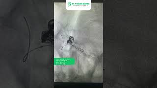 Dr Prashant Agarwal has successfully performed another aneurysm coiling procedure [upl. by Mil]