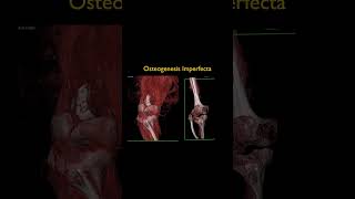 Osteogenesis Imperfecta [upl. by Immas]