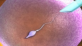 How Does Intracytoplasmic Sperm Injection Work ICSI IVF Procedure for Pregnancy Animation Video [upl. by Kimberly]