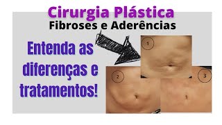 Fibroses e Aderências pós lipo abdominoplastia o que são e como melhorar [upl. by Derayne521]