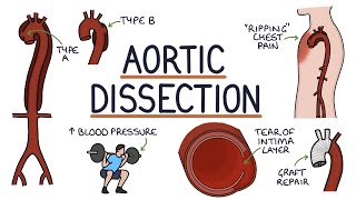 Understanding Aortic Dissection [upl. by Catharina]