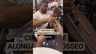 Como é uma cirurgia de alongamento ósseo das pernas [upl. by Anelrahs557]