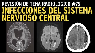 Revisión de Tema 75 Infecciones del sistema nervioso central SNC [upl. by Rayle]