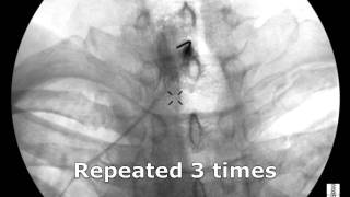 Cervical Interlaminar Epidural Steroid Injection  ThePainSourcecom [upl. by Bo978]