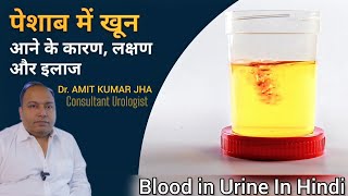 पेशाब में खून आना  Blood in urine Hematuria in Hindi  पेशाब में खून आने का कारण लक्षण और इलाज [upl. by Haimrej]