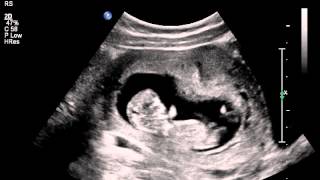 Jumping womb dancer baby ultrasound scan [upl. by Haronid]