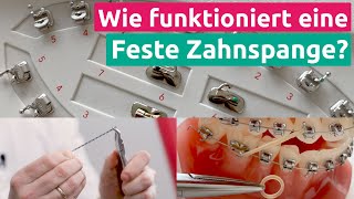 Wie genau funktioniert eigentlich eine feste Zahnspange [upl. by Lahcar]