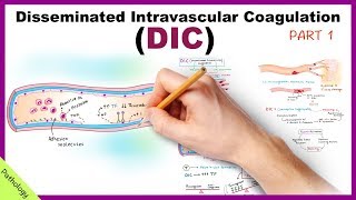 DIC Disseminated Intravascular Coagulation  Part 1 [upl. by Feil]