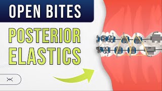 Anterior OPEN BITE  Posterior Elastics  Orthodontic Treatment [upl. by Imekawulo]