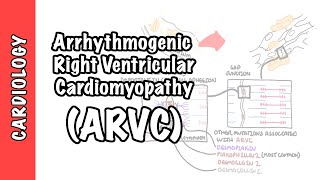 Arrhythmogenic right ventricular cardiomyopathy ARVC  pathophysiology investigations treatment [upl. by Ahsinit]