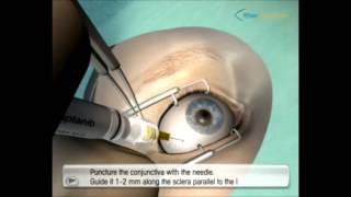 Diabetic Retinopathy Intravit Injection Video 3 [upl. by Ellehcin]