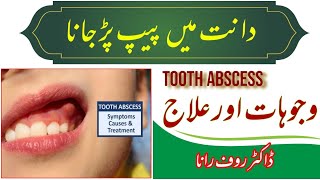 TOOTH ABSCESS DENTAL INFECTION Dental abscess  causes symptoms diagnosis treatment in UrduHindi [upl. by Brenda844]