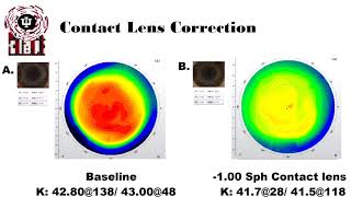 Anisometropia and Aniseikonia Treatment [upl. by Kloster520]