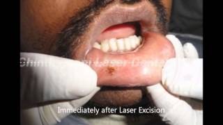 Laser Excision of Traumatic Fibroma Using Diode LaserIndia [upl. by Lettig]