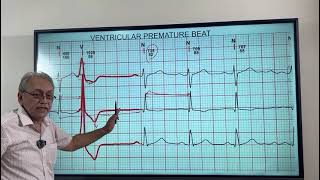 VENTRICULAR ECTOPICS  VENTRICULAR PREMATURE BEATS HOW TO DIAGNOSE ON ECG [upl. by Darrill]