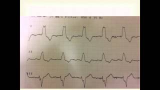 Left Bundle Branch Block [upl. by Sylirama292]