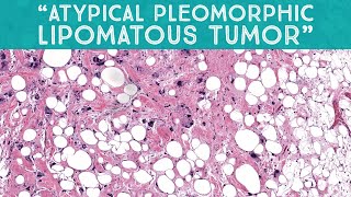 quotAtypical pleomorphic lipomatous tumorquot mimic of liposarcoma AIP France 2021  case 13 [upl. by Acimak]