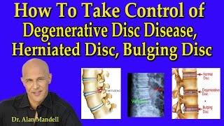 How to Take Control of Degenerative Disc Disease Herniated Disc amp Bulging Disc  Dr Mandell [upl. by Ailic]