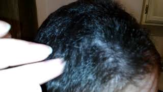 Skin Picking Insanity Another Annoying Scalp Scab Picking Video 😱 [upl. by Neelsaj]