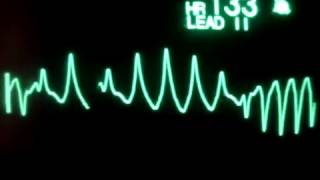 ekg ritimleri torsade de pointes [upl. by Demmy216]