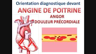 Syndrome coronarien aigu ANGINE DE POITRINE angor stable instable cours cardiologie conduite à tenir [upl. by Marcella]