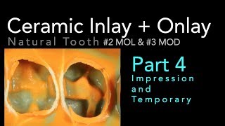 Lithium Disilicate Ceramics Part 4 Impression and Temporary [upl. by Grizel]