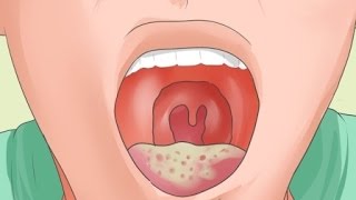 Causas y síntomas de la candidiasis bucal [upl. by Parrish]