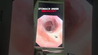 Understanding Stomach Ulcers An InDepth Look Under Endoscopy [upl. by Aenahs762]