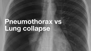 Pneumothorax vs Lung Collapse [upl. by Alaikim]