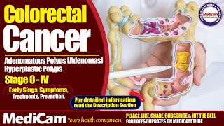 Colorectal Cancer Sings Symptoms And Treatment [upl. by Tuck727]