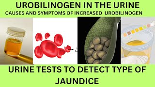 UROBILINOGEN IN THE URINE INCREASEDCAUSES SYMPTOMS OF HIGH UROBILINOGENURINE TEST FOR JAUNDICE [upl. by Hackathorn]