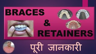 BRACES amp RETAINERS कौन सा Retainer सबसे अच्छा है किस समय लगाना है कितने समय लगाना हैखर्चा [upl. by Halueb875]