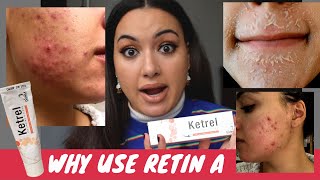 WHY USE TRETINOIN CREAM RETINOIDS FOR ACNE  My adult acne journey clear skin ✨ [upl. by Eisler970]