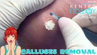 Calluses RemovalΑφαίρεση κάλωνΚέντρο Ποδιού PodiatryPodiatrist feet κεντροποδιου calluses [upl. by Hereld]