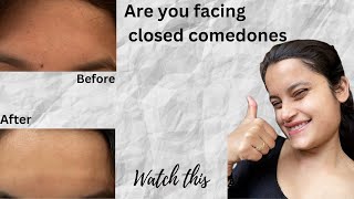 How to treat closed comedonesTiny Bumps on Forehead😱in 3weeks [upl. by Delmor]