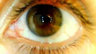 Physiologic optokinetic nystagmus [upl. by Gore]