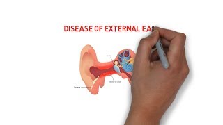 Diseases of external ear  trauma  inflammatory  neoplastic disorders2 [upl. by Abigail785]