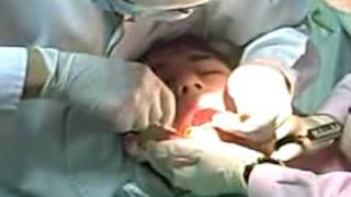 Dentistry Horrors Wisdom tooth procedure full [upl. by Dinnage]