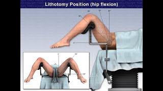 The lithotomy position The posture Degree of leg abduction and its applications positioning [upl. by Ecnar169]